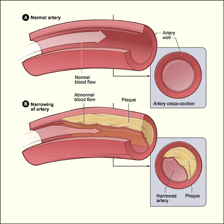 Atherosclerosis: Understanding, Treatment, and Additional Aspects